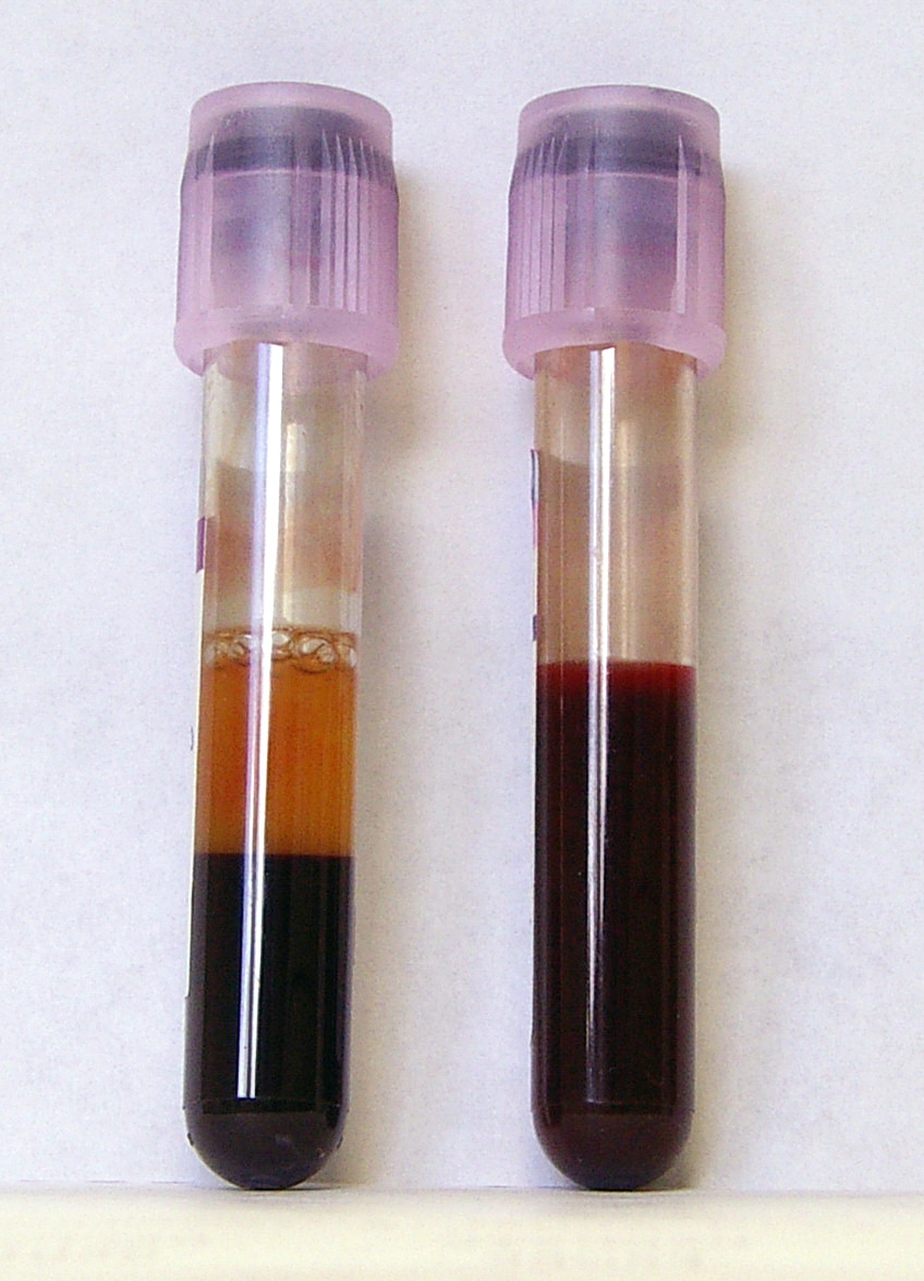 Blood samples in EDTA tubes, our current favored DNA source for whole genome sequencing. License: CC-BY-SA, by Lennart B.